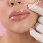 تزریق فیلر لب در صدرا