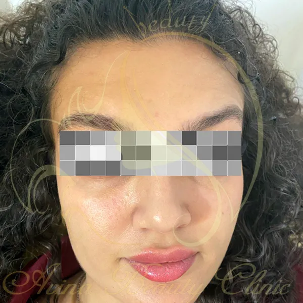 نمونه کار بعد از بوتاکس