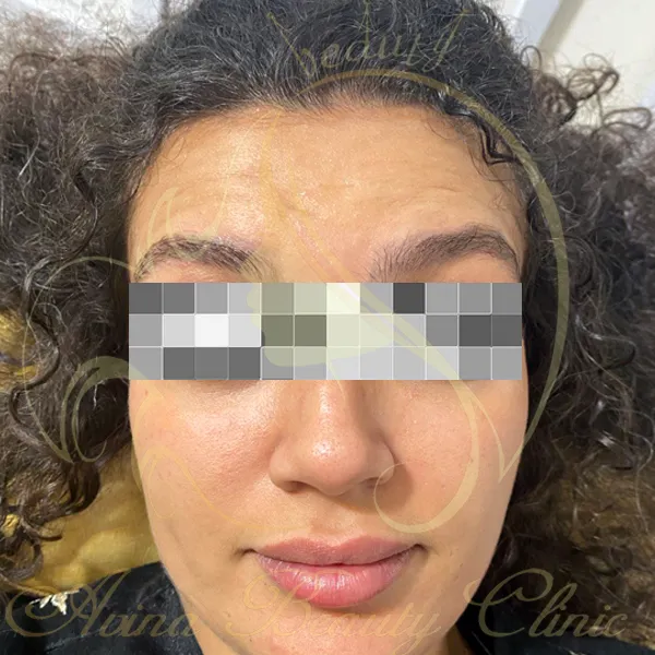 نمونه کار قبل از بوتاکس